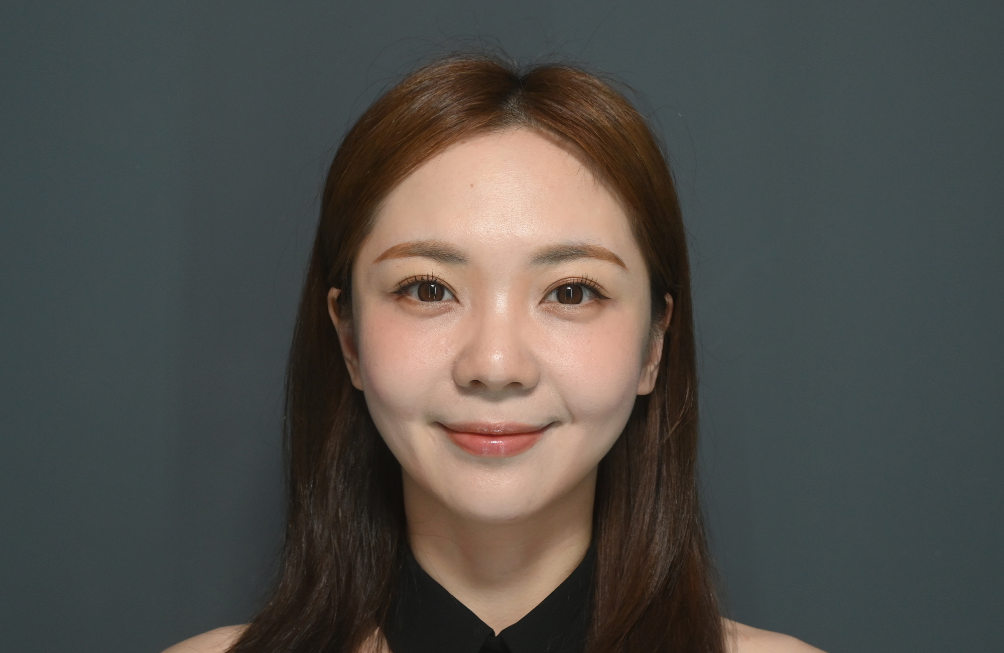 【海芙電音雙波】療程前After